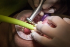 Zubaři vybrali náhradu za zakázaný míchaný amalgám v plombách