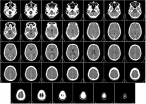 Lékaři testují novou metodu, která přinese naději nemocným s Parkinsonem
